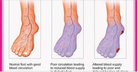 Do You Suffer From Poor Circulation Here Is How To Solve Your Problem