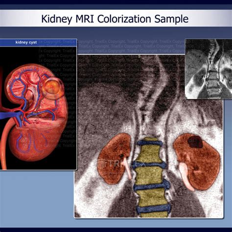 Kidney Mri Colorization Sample Trialexhibits Inc