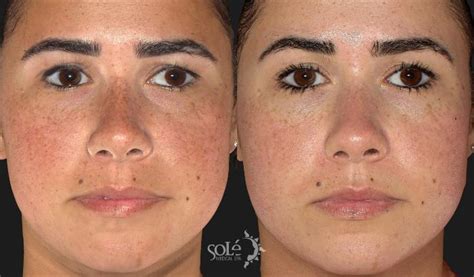 Dermal Fillers Before And After Photo Gallery Tifton Ga Solé