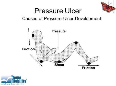 Pressure Ulcers Cause HubPages