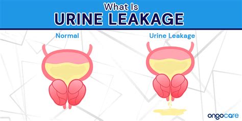 Urinary Incontinence Causes Symptoms And Treatment Ongocare