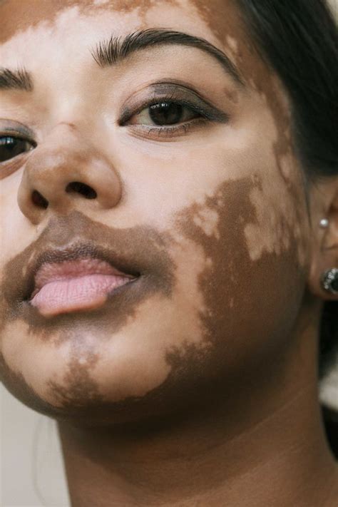 35 Beautiful Women With Vitiligo Shot By A Photographer Who Has The