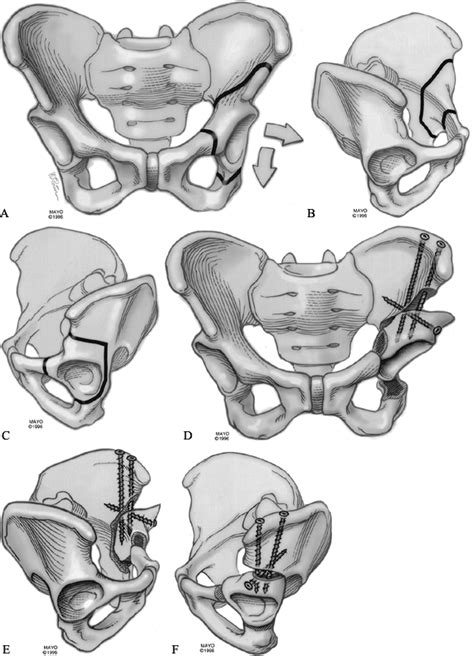 Osteotomies About The Hip—adults Teachme Orthopedics
