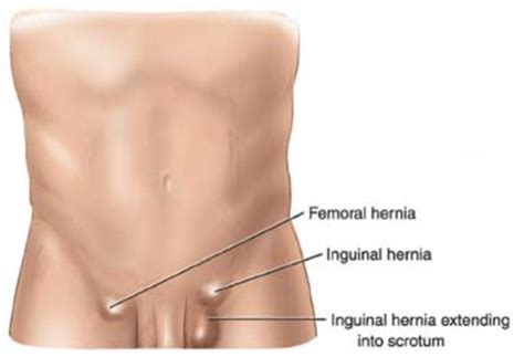 what is a groin hernia