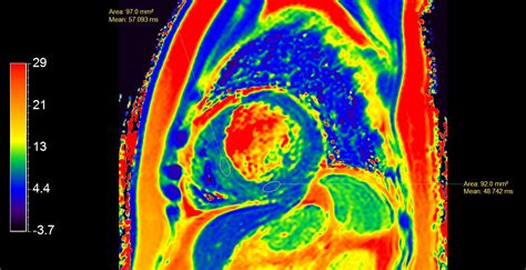 Myocardial Infarction With T1t2 Mapping Philips Mr Body Map