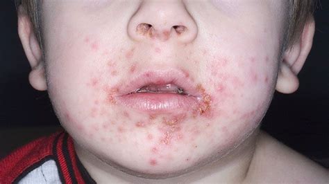 Impetigo Infeccion Bacteriana De La Piel Pediatria Salud Images
