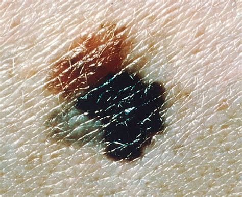 Difference Between Blood Blister And Melanoma Difference Between
