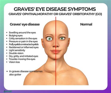 Thyroid Eye Disease Symptoms Causes Diagnosis And Treatment Photos