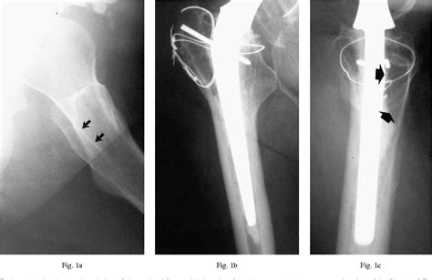 Figure 1 From The Calcar Femorale In Cemented Stem Fixation In Total