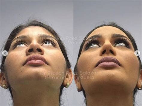 Cosmetic Surgery Photos Of Miss Venezuela Go Viral After She Becomes