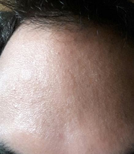 Small Raised Bumps On Forehead Pictures Photos Rezfoods Resep