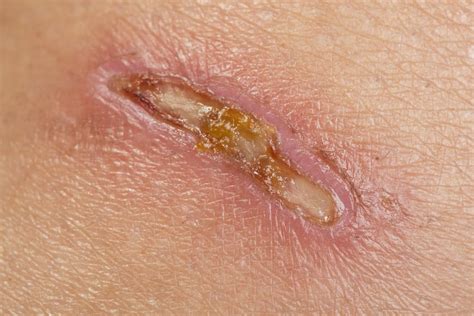 Can A Wound Heal With Pus In It