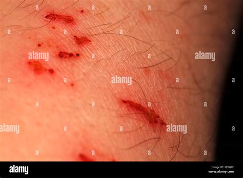 Scabs Skin High Resolution Stock Photography And Images Alamy