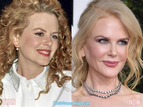 Nicole Kidman Plastic Surgery Before After Pics