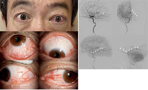 A Proptosis And Corkscrew Hyperaemia With Dilated Scleral Vessels Were