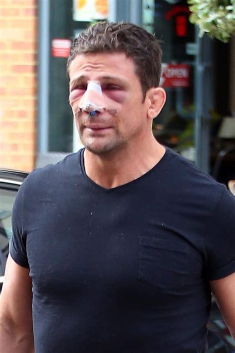 Former Cage Fighter Alex Reid Emerges With Disturbing Facial Injury In