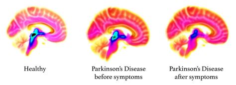 New Brain Imaging Study Reveals Signs Of Parkinsons Decades Before