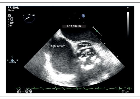Figure 1 From Fistulous Periprosthetic Aortic Abscess To The Left