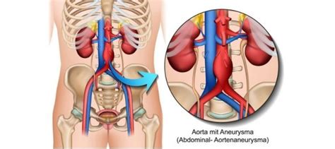 Getting Familiar With Abdominal Aortic Aneurysm Virchicago