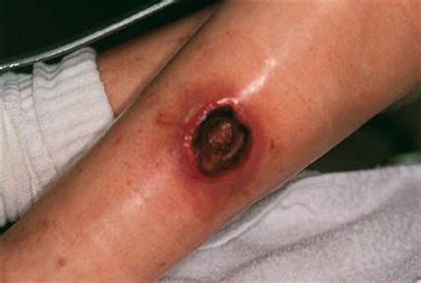 👉 Brown Recluse Spider Bite Pictures Symptoms Stages Treatment