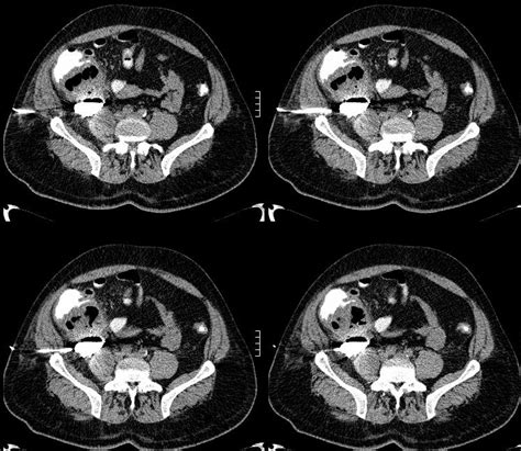 The pain was usually generalized but sometimes radiated to the right iliac fossa. Male patient 47 years old presenting with severe right ...
