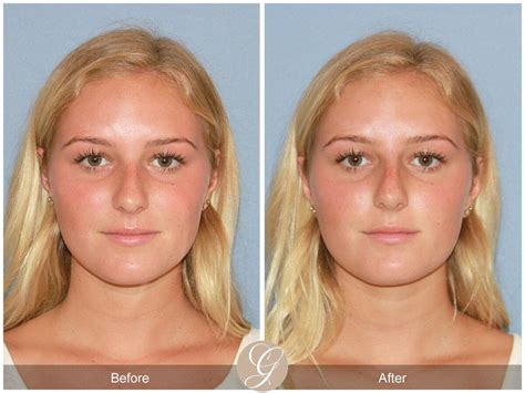 Before And After Tip Rhinoplasty Procedures In Newport Beach Ca Orange County Facial Plastic Surgeon