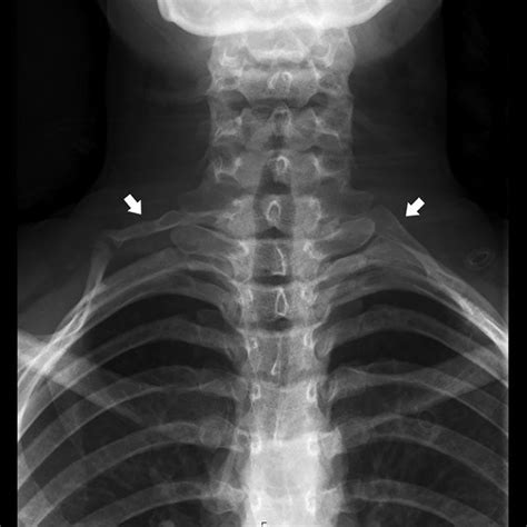 Pdf Radiologic Confirmation Of Bilateral Cervical Ribs In An Adolescent