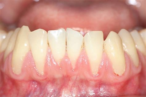 Receding Gums Dentist Hutto Tx Solis Dental