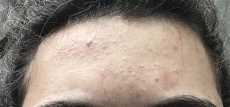 Acne Im Considering Dermarolling To Help W Some Of My