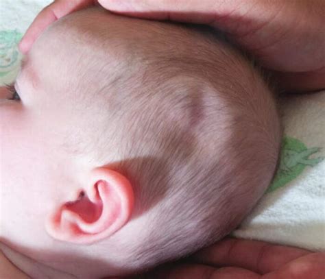 5 Common Birth Injury Symptoms In Infants The Washington Note