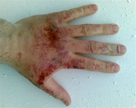 Chemical Burns Symptoms Diagnosis And Treatment