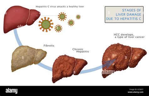 Diagram Of Liver Cirrhosis Liver And Cholesterol Whats The Link