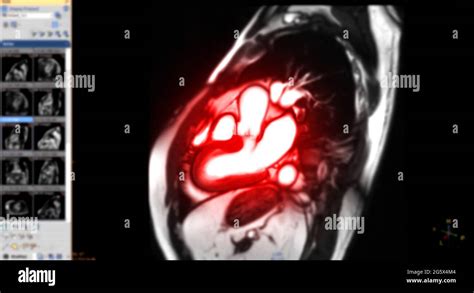 Imágenes de resonancia magnética cardiaca o cardiaca IRM del corazón en
