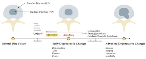 The Anatomy And Pathophysiology Of Intervertebral Disc Disease The