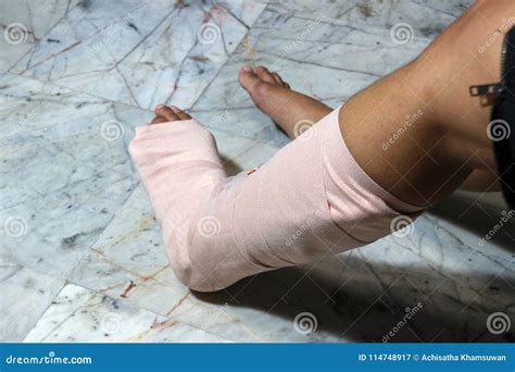 Left Legs And Feet Be In Plaster Cast Because Splintered Stock Image
