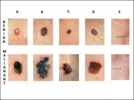 How do i know if i have melanoma? and. What is Melanoma Skin Cancer? | SERO