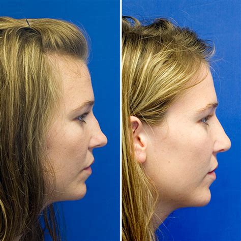 Saddle Nose Deformity Rhinoplasty In Seattle Rhinoplasty Surgeon