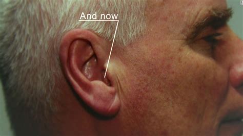 Pitch Perfect The Quest To Create The Worlds Smallest Hearing Aid Cnn