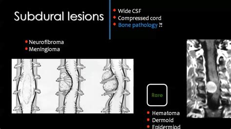 Pin by Dr abuaiad on spinal | Pathology, Spinal cord ...