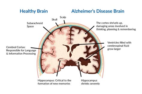 Alzheimer S Disease Neuropedia