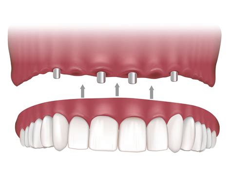 What Are Permanent Dentures Implant Retained Dentures In Calgary