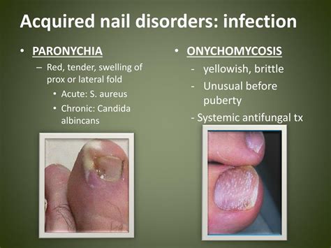 Ppt Case Conference Nail Disorders Powerpoint Presentation Free