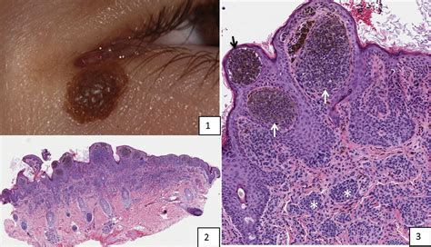 Papillomatous Compound Nevus Ophthalmology