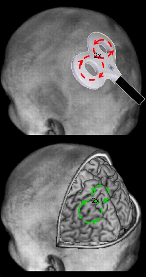 Transcranial Magnetic Stimulation Disrupting Neural Activity To Alter