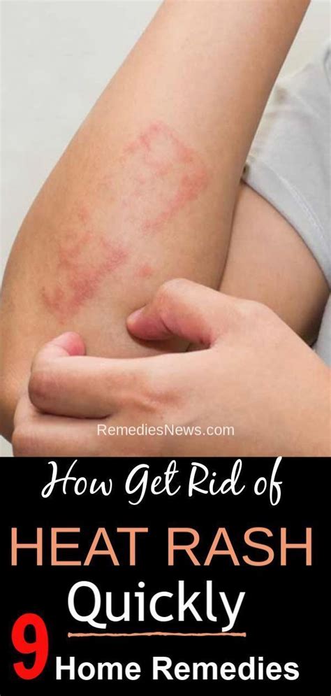 How To Get Rid Of Heat Rash Quickly 9 Natural Remedies For Heat Rash
