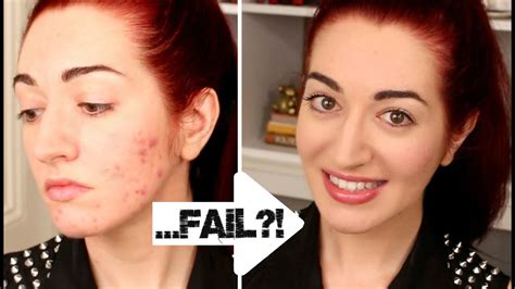 How To Quickly Cover Acne And Scarring 5 Minute Makeup