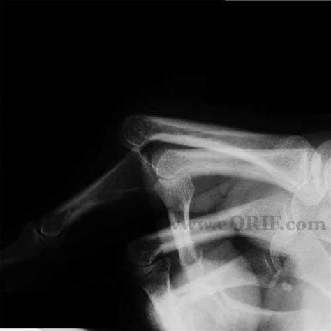 PIP Fracture / Dislocation S63.279A 834.02 | eORIF