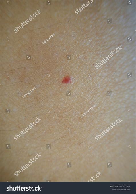 Red Spot On Skin Texture Skin Stock Photo 1442447960 Shutterstock