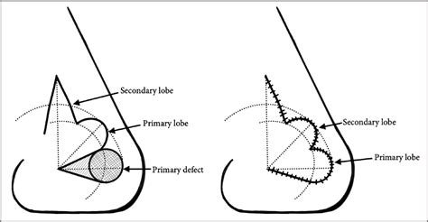 Figure From Geometric Analysis Of The Bilobed Flap For Nasal