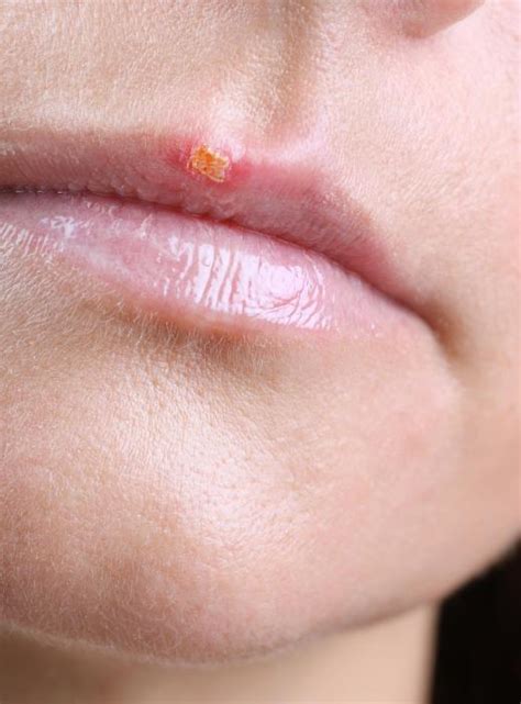 How Do I Treat A Cold Sore In The Nose With Pictures